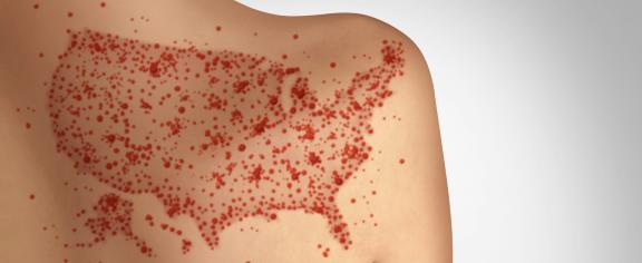 Measles infections send 1 in 5 people to the hospital.